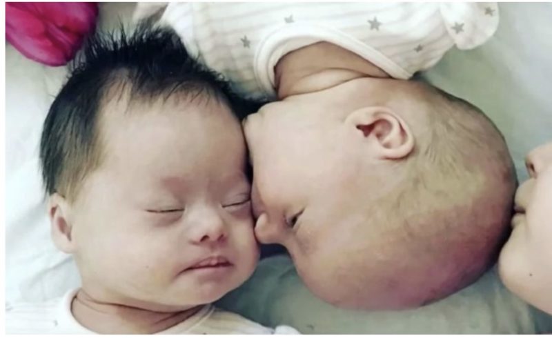 "Un caso su un milione": le gemelle più insolite al mondo sono nate in questa famiglia
