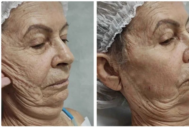 "È irriconoscibile dopo la chirurgia plastica": la donna anziana si trasforma in una giovane bellezza